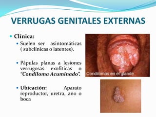 VERRUGAS GENITALES EXTERNAS
 Clínica:
    Suelen ser asintomáticas
     ( subclínicas o latentes).

   Pápulas planas a lesiones
    verrugosas exofíticas o
    “Condiloma Acuminado”.

   Ubicación:         Aparato
    reproductor, uretra, ano o
    boca
 