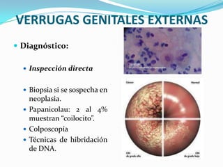 VERRUGAS GENITALES EXTERNAS
 Diagnóstico:

   Inspección directa


   Biopsia si se sospecha en
    neoplasia.
   Papanicolau: 2 al 4%
    muestran “coilocito”.
   Colposcopía
   Técnicas de hibridación
    de DNA.
 