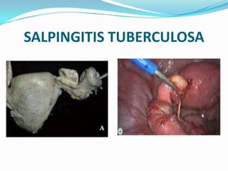 SALPINGITIS TUBERCULOSA
 