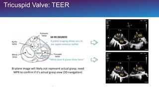 Noninvasive Assessment of Right Ventricle and Tricuspid Valve | PDF