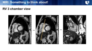 Noninvasive Assessment of Right Ventricle and Tricuspid Valve | PDF