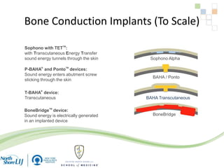 Bone Conduction Implants (To Scale)
BoneBridge
BAHA / Ponto
BAHA Transcutaneous
Sophono Alpha
Sophono with TETTM
:
with Transcutaneous Energy Transfer
sound energy tunnels through the skin
P-BAHA®
and PontoTM
devices:
Sound energy enters abutment screw
sticking through the skin
T-BAHA®
device:
Transcutaneous
BoneBridgeTM
device:
Sound energy is electrically generated
in an implanted device
 