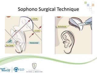 Sophono Surgical Technique
 