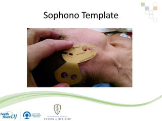 Sophono Template
 