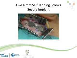 Five 4 mm Self Tapping Screws
Secure Implant
 