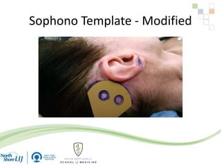 Sophono Template - Modified
 