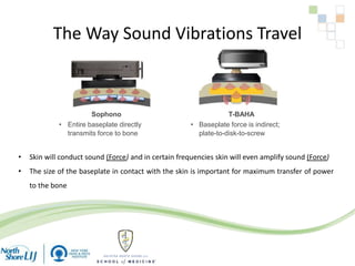 The Way Sound Vibrations Travel
Sophono
• Entire baseplate directly
transmits force to bone
T-BAHA
• Baseplate force is indirect;
plate-to-disk-to-screw
• Skin will conduct sound (Force) and in certain frequencies skin will even amplify sound (Force)
• The size of the baseplate in contact with the skin is important for maximum transfer of power
to the bone
 