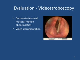 42
Evaluation - Videostroboscopy
• Demonstrates small
mucosal motion
abnormalities
• Video-documentation
 