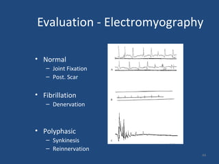 44
Evaluation - Electromyography
• Normal
– Joint Fixation
– Post. Scar
• Fibrillation
– Denervation
• Polyphasic
– Synkinesis
– Reinnervation
 