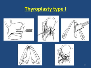 Thyroplasty type I
53
 