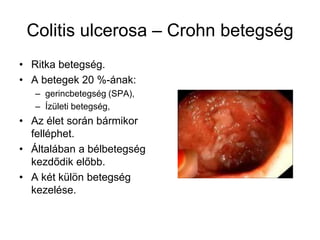 Colitis ulcerosa – Crohn betegség
• Ritka betegség.
• A betegek 20 %-ának:
– gerincbetegség (SPA),
– Ízületi betegség,
• Az élet során bármikor
felléphet.
• Általában a bélbetegség
kezdődik előbb.
• A két külön betegség
kezelése.
 