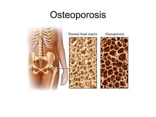Osteoporosis
 