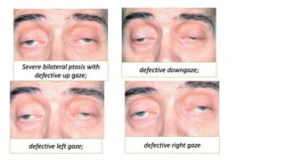 Severe bilateral ptosis with
defective up gaze;
defective downgaze;
defective left gaze; defective right gaze
 