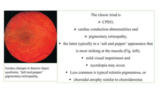 The classic triad is
 CPEO,
 cardiac conduction abnormalities and
 pigmentary retinopathy,
 the latter typically in a ‘salt and pepper’ appearance that
is most striking at the macula (Fig. left);
 mild visual impairment and
 nyctalopia may occur.
 Less common is typical retinitis pigmentosa, or
 choroidal atrophy similar to choroideremia
Fundus changes in Kearns–Sayre
syndrome. ‘Salt and pepper’
pigmentary retinopathy;
 