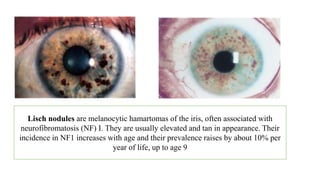 Lisch nodules are melanocytic hamartomas of the iris, often associated with
neurofibromatosis (NF) I. They are usually elevated and tan in appearance. Their
incidence in NF1 increases with age and their prevalence raises by about 10% per
year of life, up to age 9
 