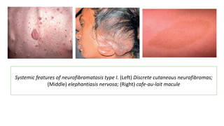 Systemic features of neurofibromatosis type I. (Left) Discrete cutaneous neurofibromas;
(Middle) elephantiasis nervosa; (Right) cafe-au-lait macule
 