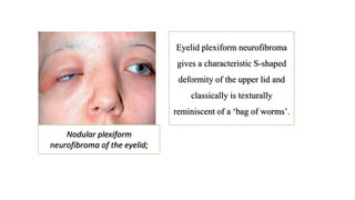 Eyelid plexiform neurofibroma
gives a characteristic S-shaped
deformity of the upper lid and
classically is texturally
reminiscent of a ‘bag of worms’.
Nodular plexiform
neurofibroma of the eyelid;
 
