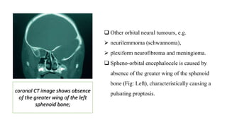  Other orbital neural tumours, e.g.
 neurilemmoma (schwannoma),
 plexiform neurofibroma and meningioma.
 Spheno-orbital encephalocele is caused by
absence of the greater wing of the sphenoid
bone (Fig: Left), characteristically causing a
pulsating proptosis.
coronal CT image shows absence
of the greater wing of the left
sphenoid bone;
 