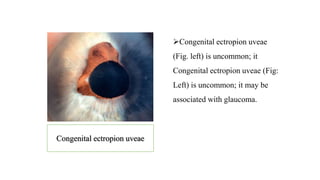 Congenital ectropion uveae
(Fig. left) is uncommon; it
Congenital ectropion uveae (Fig:
Left) is uncommon; it may be
associated with glaucoma.
Congenital ectropion uveae
 