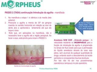 BACH
                                                                                                        TECH



PASSO 2 (TASA) continuação Introdução da agulha - mandíbula

1.   Na mandíbula a etapa 1 é idêntica à da maxila (tela
     anterior)
2.   Posicione a agulha a menos de 30º da gengiva                                              No final do PASSO 2 o
     inserida no sentido horizontal em relação ao eixo do                                      Display mostra : 0.20 ml
                                                                                               (0.10 - Punção inicial e,
     dente alvo e aprofunde-a lentamente até que ela                                           0.10 – Introd. da agulha
     toque o osso.
3.    Note que, em aplicações na mandíbula, não é
     necessário levar a agulha até a região periapical. Ao
     tocar o osso, está pronto para iniciar o PASSO 3.
                                                                  Anestesia SEM DOR ...Entenda porque : A
                                                                  velocidade residente no MORPHEUS para a
                                                                  função de introdução da agulha é programada
                                                                  no tempo de fluxo exato para que a permeação
                                                                  do líquido anestésico através do osso seja
                                                                  plena, sem acumulo de qualquer quantidade de
                                                                  droga, evitando assim o descolamento do tecido
                                                                  perióstico e conseqüentes traumas teciduais.
                                                                  Por isto não há dor nos procedimentos
                                                                  operatórios e tampouco no pós operatório.
            Sentido da movimentação da agulha
                                                Técnica Anestésica TASA                                          79
 