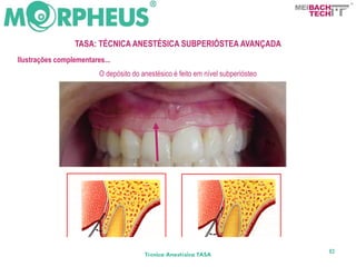 BACH
                                                                                  TECH



                 TASA: TÉCNICA ANESTÉSICA SUBPERIÓSTEA AVANÇADA
Ilustrações complementares...
                         O depósito do anestésico é feito em nível subperiósteo




                                                                                     83
                                        Técnica Anestésica TASA
 