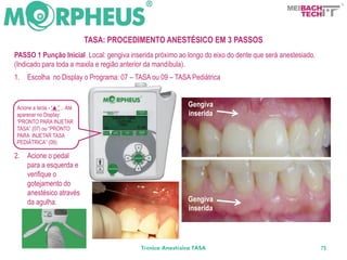 BACH
                                                                                                TECH


                               TASA: PROCEDIMENTO ANESTÉSICO EM 3 PASSOS
PASSO 1 Punção Inicial Local: gengiva inserida próximo ao longo do eixo do dente que será anestesiado.
(Indicado para toda a maxila e região anterior da mandíbula).
1.   Escolha no Display o Programa: 07 – TASA ou 09 – TASA Pediátrica


 Acione a tecla - “▲”... Até
                                                            Gengiva
 aparecer no Display:                                       inserida
 “PRONTO PARA INJETAR
 TASA” (07) ou “PRONTO
 PARA INJETAR TASA
 PEDIÁTRICA” (09).

2.   Acione o pedal
     para a esquerda e
     verifique o
     gotejamento do
     anestésico através
     da agulha.                                             Gengiva
                                                            inserida




                                            Técnica Anestésica TASA                                      75
 