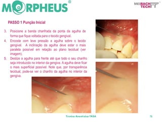 BACH
                                                                           TECH



     PASSO 1 Punção Inicial

3.    Posicione a banda chanfrada da ponta da agulha de
      forma que fique voltada para o tecido gengival.
4.    Encoste com leve pressão a agulha sobre o tecido
      gengival. A inclinação da agulha deve estar o mais
      paralela possível em relação ao plano tecidual (ver
      imagem).
5.    Deslize a agulha para frente até que todo o seu chanfro
      seja introduzido no interior da gengiva. A agulha deve ficar
      o mais superficial possível. Note que, por transparência
      tecidual, pode-se ver o chanfro da agulha no interior da
      gengiva.




                                                 Técnica Anestésica TASA      76
 