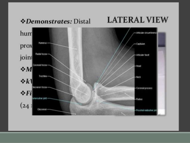 icd 10 code closed supracondylar fracture elbow icd 10 code closed supracondylar fracture elbow