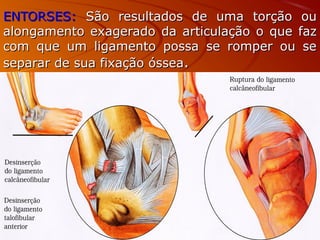 ENTORSES:ENTORSES: São resultados de uma torção ouSão resultados de uma torção ou
alongamento exagerado da articulação o que fazalongamento exagerado da articulação o que faz
com que um ligamento possa se romper ou secom que um ligamento possa se romper ou se
separar de sua fixação ósseaseparar de sua fixação óssea..
 