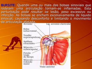 BURSITE:BURSITE: Quando uma ou mais das bolsas sinoviais queQuando uma ou mais das bolsas sinoviais que
rodeiam uma articulação tornam-se inflamadas. Estarodeiam uma articulação tornam-se inflamadas. Esta
perturbação pode resultar de lesão, peso excessivo ouperturbação pode resultar de lesão, peso excessivo ou
infecção. As bolsas se enchem excessivamente de líquidoinfecção. As bolsas se enchem excessivamente de líquido
sinovial, causando desconforto e limitando o movimentosinovial, causando desconforto e limitando o movimento
da articulação afetada.da articulação afetada.
 
