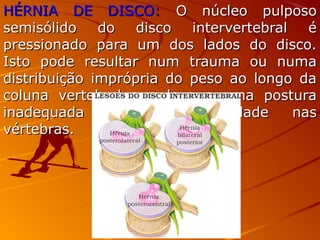 HÉRNIA DE DISCO:HÉRNIA DE DISCO: O núcleo pulposoO núcleo pulposo
semisólido do disco intervertebral ésemisólido do disco intervertebral é
pressionado para um dos lados do disco.pressionado para um dos lados do disco.
Isto pode resultar num trauma ou numaIsto pode resultar num trauma ou numa
distribuição imprópria do peso ao longo dadistribuição imprópria do peso ao longo da
coluna vertebral que leva a uma posturacoluna vertebral que leva a uma postura
inadequada ou a deformidade nasinadequada ou a deformidade nas
vértebras.vértebras.
 