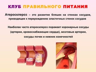 КЛУБ ПРАВИЛЬНОГО ПИТАНИЯ
Атеросклероз – это развитие бляшек на стенках сосудов,
  приводящее к перерождению эластичных стенок сосудов


 Наиболее часто атеросклероз поражает коронарные сосуды
   (артерии, кровоснабжающие сердце), мозговые артерии,
            сосуды почек и нижних конечностей
 