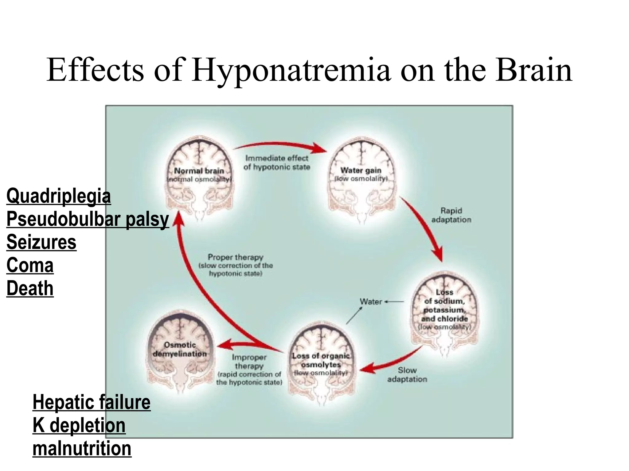 Effects of Hyponatremia on the Brain
Quadriplegia
Pseudobulbar palsy
Seizures
Coma
Death
Hepatic failure
K depletion
malnutrition
 