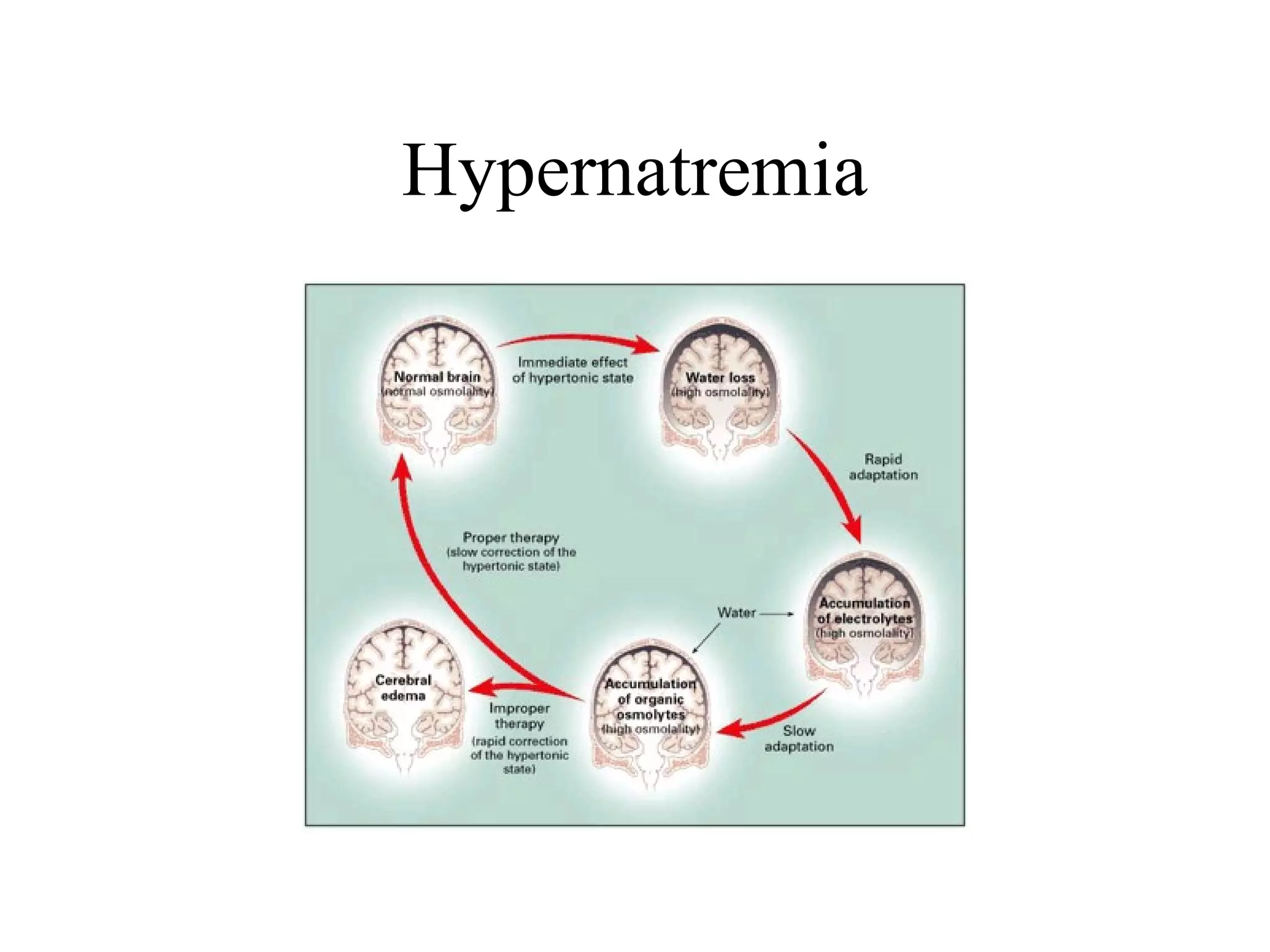 Hypernatremia
 