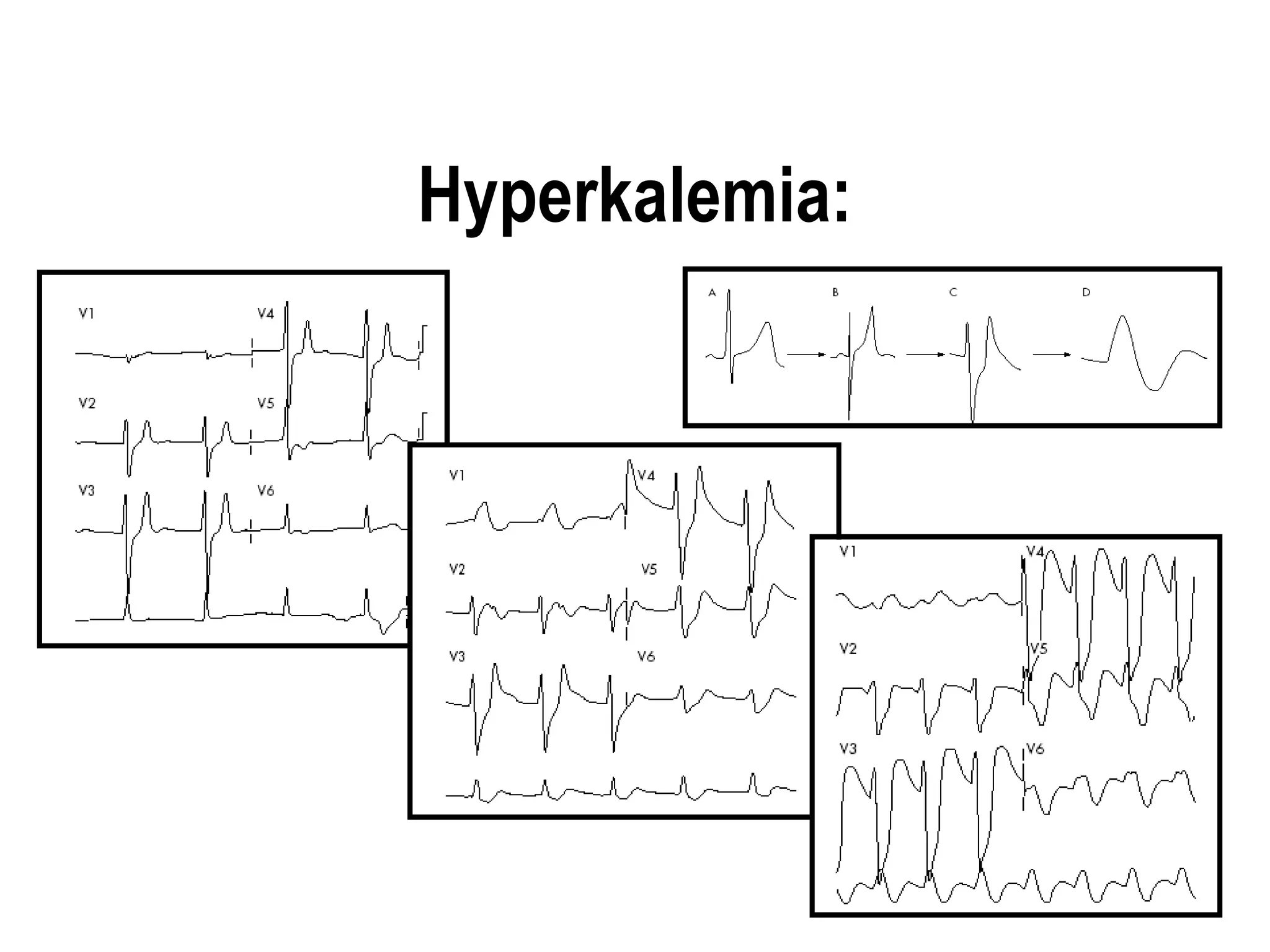 Hyperkalemia:
 