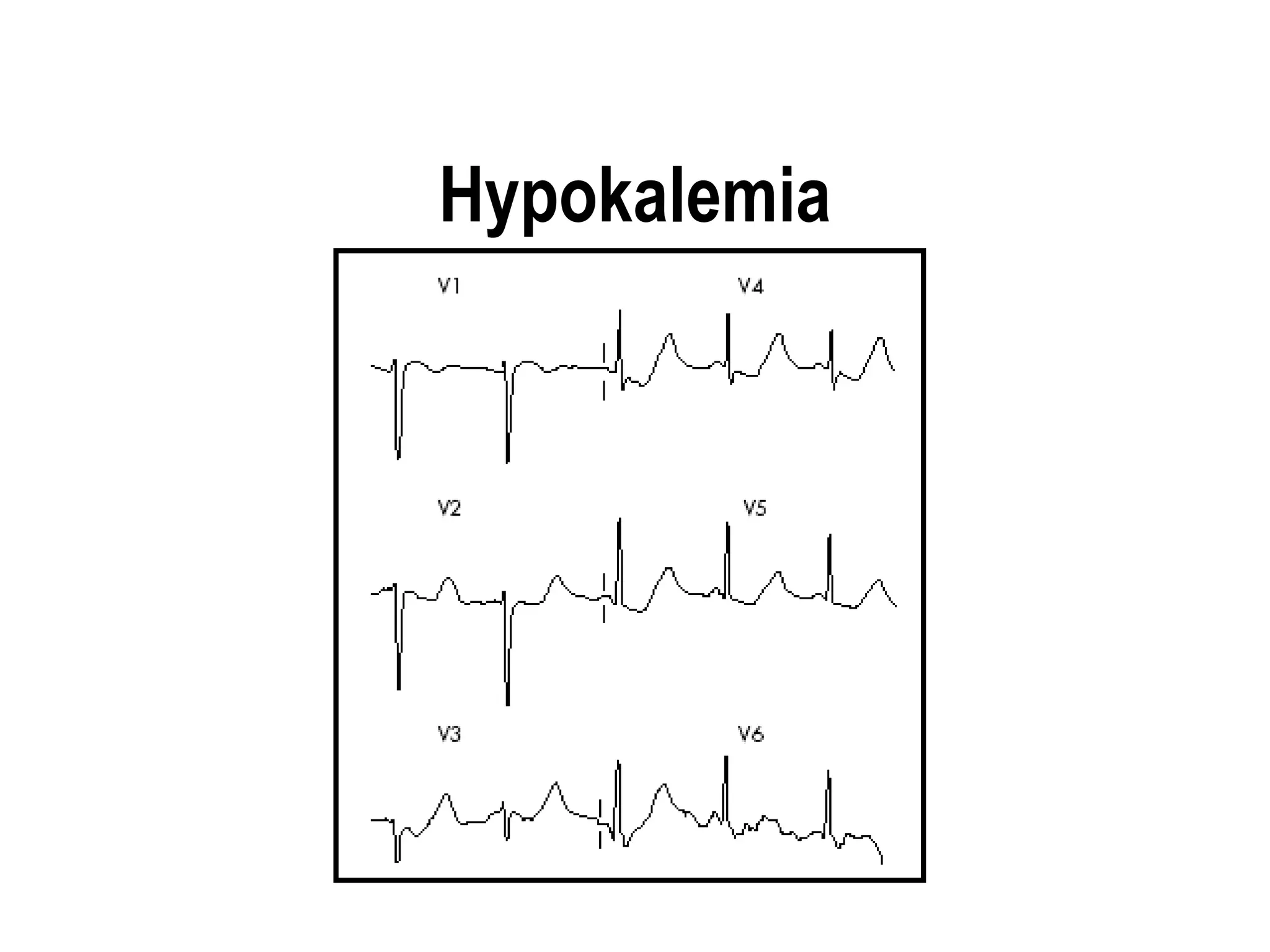 Hypokalemia
 
