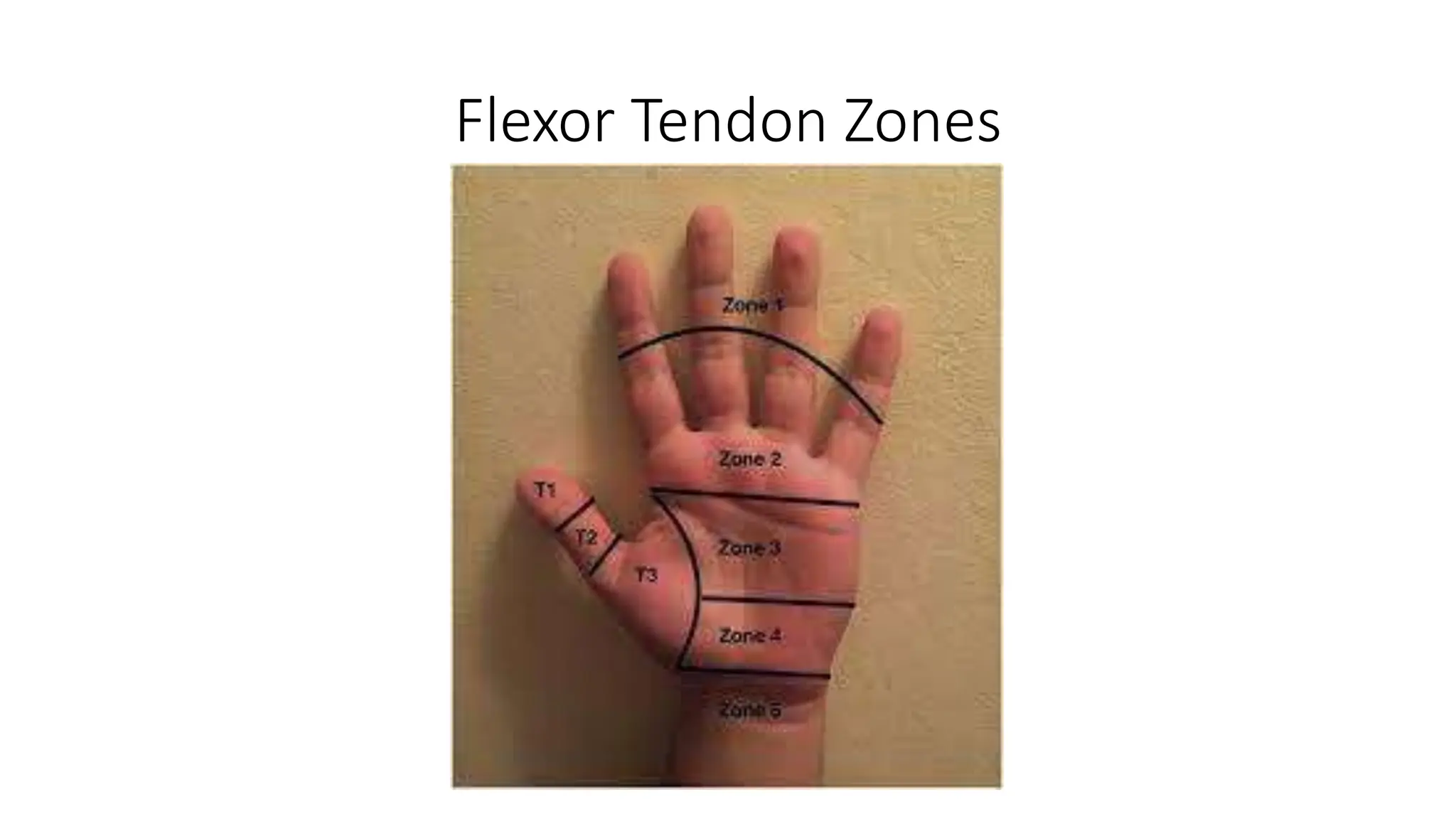Hand flexor tendon repair basics 40 characters | PPT