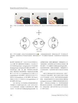 Benign Paroxysmal Positional Vertigo
304 Formosan J Med 2023 Vol.27 No.3
幢⦧⊊ᶳ柕悐⠲檀 30°炻⃰⽆㬋ᷕỵὅ⸷⮯柕⎹ⶎ
⎹⎛⎬廱 90°ẍ奨⮇䛤㋗㚱䃉(⚾Ḽ)ˤ劍↢䎦㯜⸛
䘬⎹⛘䛤㋗(geotropic nystagmus)ㆾ㯜⸛䘬微⛘䛤
㋗(apogeotropic nystagmus)⌛姢㕟䁢 HC-BPPV炻↮
⇍姀抬䁢 ˣ 炻╖䭕柕堐䣢庫⻙“
䛤㋗炻暁䭕柕堐䣢庫⻟“䛤㋗ˤ㍐婾ℑ侭䘬农䕭㨇
廱 ↮ ⇍ 䁢 䭉 俛 䞛 (canalithiasis) ␴ 枪 ⷥ 㰱 䞛
(cupulolithiasis)炻HC-BPPV ↮栆䁢䭉俛䞛✳㯜⸛⋲
夷䭉俛䞛䕯(canalithiasis of HC-BPPV, HC-Can)⍲
枪ⷥ㰱䞛✳㯜⸛⋲夷䭉俛䞛䕯(cupulolithiasis of
HC-BPPV, HC-Cup)ˤ
䁢ỽ HC-Can ⏰⎹⛘䛤㋗ᶼ䛤㋗庫⻟“䁢か
俛“(⚾ℕ)烎ὅ㒂 Ewald 㮷䫔Ḵ⭂⼳炻䔞俛䞛ỵ㕤
㯜⸛⋲夷䭉⼴兪炻䕭か幢ᶳᶼ柕悐⠲檀 30°炻廱柕
⎹か俛炻俛䞛㛅⎹か俛⢢儡(ampullopetal)㺦≽炻忈
ㆸ冰⤖⿏⇢㽨炻枪ⷥ⎹♲“ῷ䦣炻枪ⷥῷ䦣䘬㕡⎹
䁢䛤㋗ㄊ䚠炻㓭婀䘤㛅⎹か俛䘬庫⻟⎹⛘䛤㋗ˤ廱
柕⎹‍俛炻俛䞛怈暊か俛⢢儡(ampullofugal)㺦≽炻
忈ㆸ㈹⇞⿏⇢㽨炻枪ⷥ⎹䭉“ῷ䦣炻枪ⷥῷ䦣䘬㕡
⎹䁢䛤㋗ㄊ䚠炻㓭婀䘤㛅⎹‍俛䘬庫⻙⎹⛘䛤㋗
[14]ˤ
1985 ⸜ McClure[15]椾㫉䘤堐㬌䕦䕭炻㓞普Ḯ
7 ἳ䘮㗗㕤⸛幢⦧⊊㗪炻柕⎹⎛“ㆾⶎ“⛯⎗婀䘤
↢㯜⸛⎹⛘䛤㋗炻ᶼ⛐㝸ᶨ“Ἕ㚱庫⻟䘬䛑㘰デ␴
䛤㋗ˤ䛤㋗庫⻟“ⷠỜ㚱冒䘤⿏䘬䛤㋗⍵廱䎦尉
(nystagmus inversion)炻⌛廱柕⎹䛤㋗庫⻟“䘬か俛
“㗪炻ᶨ攳⥳㚫⏰⎹⛘䛤㋗炻Ữᶨ㭝㗪攻⼴䛤㋗㚫
廱䁢庫⻙䘬微⛘䛤㋗烊Ữ㗗䔞柕廱⎹‍俛“㩊㞍
㗪炻⇯䃉㬌䎦尉ˤ⚳ℏ椾ἳ HC-Can 䓙㛶⍲恙[16]
㕤 1999 ⸜䘤堐ˤ
კϖǺѳ፴ΠѰѓୁ፴ᔠࢗǶᡣੰ஻һ፴࠮༈Πᓐ೽პଯ 30°ǴӃவ҅ύՏ٩‫ׇ‬ஒᓐӛѰӛѓӚᙯ 90°аᢀჸ౳ਁԖ
คǶ
კϤǺᆅԸҡ‫ޑ‬ᐒᙯǶр౜Нѳ‫ޑ‬ӛӦ౳ਁࣁ HC-Can( ) ǴЪ౳ਁၨமୁࣁ஻ԸǶᙯᓐӛ஻(Ѱ)ԸǴԸҡරӛѰԸ
൙ဎᄾ୏ǴࡺᇨวරӛѰԸ‫ޑ‬ၨமӛӦ౳ਁǶᙯᓐӛ଼(ѓ)ԸǴԸҡᇻᚆ஻Ը൙ဎᄾ୏ǴࡺᇨวරӛѓԸ‫ޑ‬ၨ১ӛӦ
౳ਁǶ
 