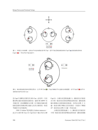 Benign Paroxysmal Positional Vertigo
306 Formosan J Med 2023 Vol.27 No.3
㗗 Cup-C 㚫廱䁢⎴“俛䘬 HC-Can炻㬌㗪ℵᶨ㫉㊩
临⦧⊊㱽幢⎹䛤㋗庫⻙“⌛㗗ˤ⃀䭉 HC-BPPV 㚱
⣂䧖Ṇ✳炻农䕭㨇廱䓂䁢⣂㧋炻Ữ⎗㬠䲵䁢幢⎹䛤
㋗庫⻙“䘬㊩临⦧⊊㱽(⚾ḅ)䁢℞㱣䗪⍇⇯炻䃉枰
侫ㄖか俛䁢ỽ“[20]ˤ
1998 ⸜ Gufoni 䫱[24]㍸↢ Gufoni maneuver炻
㬌㱽⎗㱣䗪 HC-Can ␴ Cup-C(Ữᶵ怑⎰䓐㕤㱣䗪
Cup-U)ˤ㱣䗪⎹⛘✳䛤㋗(⚾⋩)炻嬻䕭か⛸㕤㩊㞍
⸲ᷕ攻炻㩊㞍侭㈞叿䕭か暁偑朊⮵䕭か炻嬻䕭か“
幢⎹‍“(⎹⛘䛤㋗庫⻙“)⼴炻ᾅ㊩㬌⦧⊊ 2 ↮
揀炻㩊㞍侭暁ㇳ廱㈞军か侭柕悐炻⾓忇⎹ᶳ廱柕
45° ⼴ᾅ㊩㬌⦧⊊ 2 ↮揀炻䃞⼴⛸崟ˤ
㱣䗪微⛘✳䛤㋗(⚾⋩ᶨ)炻嬻䕭か⛸㕤㩊㞍⸲
ᷕ攻炻㩊㞍侭㈞叿䕭か暁偑朊⮵䕭か炻嬻䕭か“幢
კΖǺഗ൰؈ҡ‫ޑ‬ᐒᙯǶр౜Нѳ‫ޑ‬଍Ӧ౳ਁࣁ HC-CupǴ஻Ըёૈࢂ౳ਁၨமୁ‫ޑ‬ Cup-U( )‫܈‬౳ਁၨ১ୁ‫ޑ‬
Cup-C( )Ǵջ‫ٿ‬Ըࣣёૈࣁ஻ԸǶ
კΐǺ፴ӛ౳ਁၨ১ୁ‫࠮ុ࡭ޑ‬༈‫ݤ‬ǶѰԸ HC-Can( )ǵCup-U( )‫ޑ‬Ըҡ‫ޔ‬ௗ߇ӣᐍ༝៶ǴѓԸ Cup-C( )‫ޑ‬Ըҡ
཮ᙯࣁӕୁԸ‫ޑ‬ HC-CanǶ
 