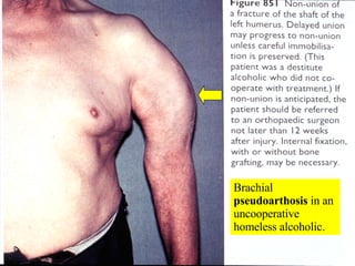 Brachial  pseudoarthosis  in an uncooperative homeless alcoholic. 