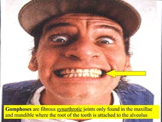 Gomphoses  are fibrous  synarthrotic  joints only found in the maxillae and mandible where the root of the tooth is attached to the alveolus 
