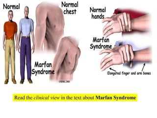 Read the  clinical view  in the text about  Marfan Syndrome 