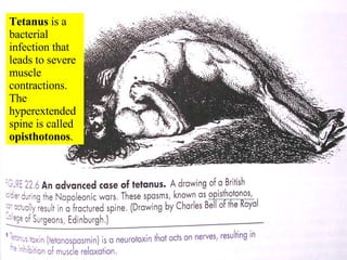 Tetanus  is a bacterial infection that leads to severe muscle contractions.  The hyperextended spine is called  opisthotonos . 