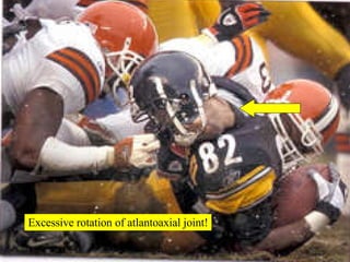 Excessive rotation of atlantoaxial joint! 