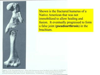Shown is the fractured humerus of a Native American that was not immobilized to allow healing and fusion.  It eventually progressed to form a false joint ( pseudoarthrosis ) in the brachium. 
