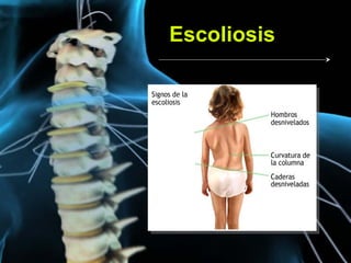 Escoliosis
 