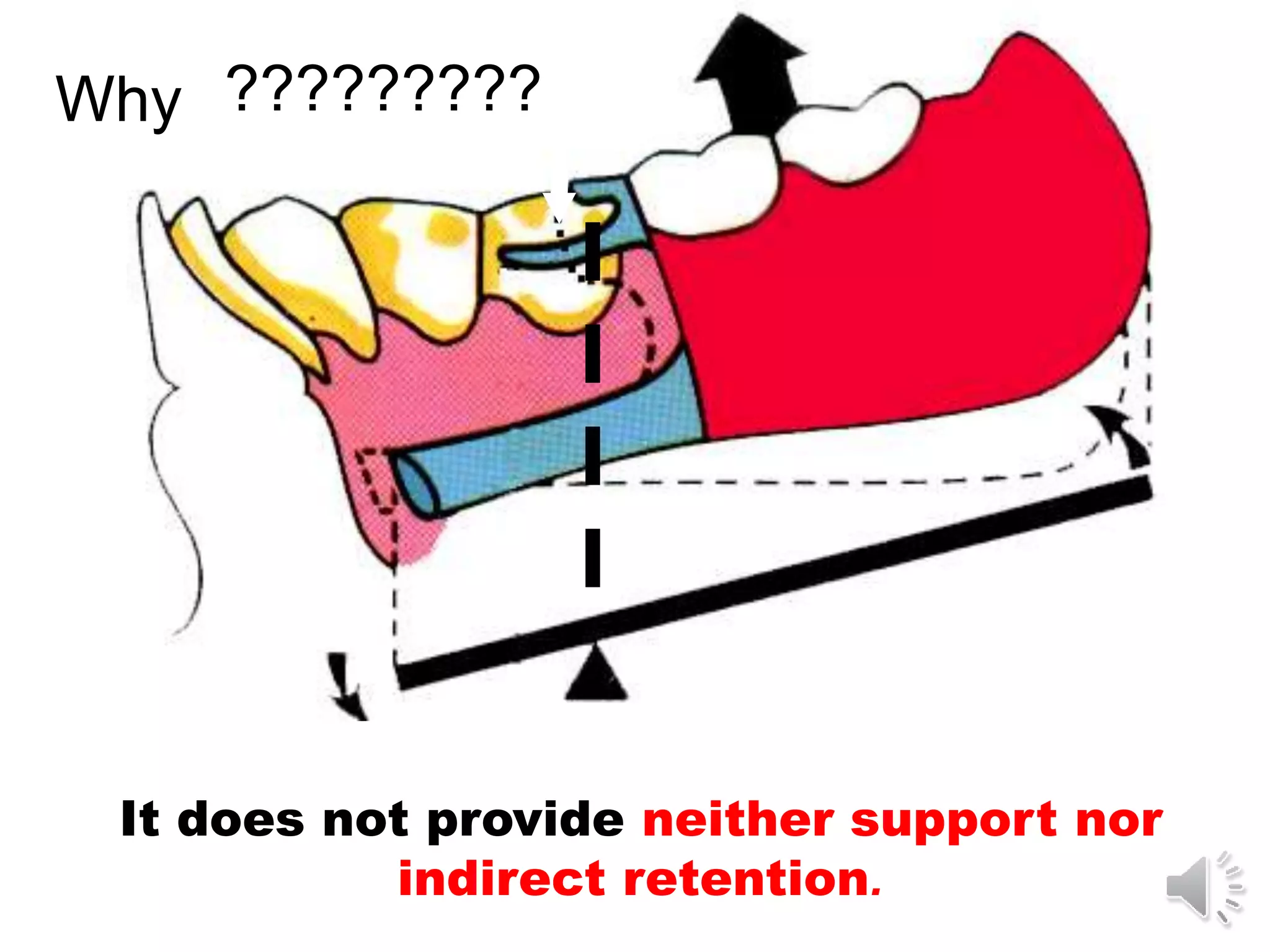 Mandibular major and minor connectors of RPDs | PPT