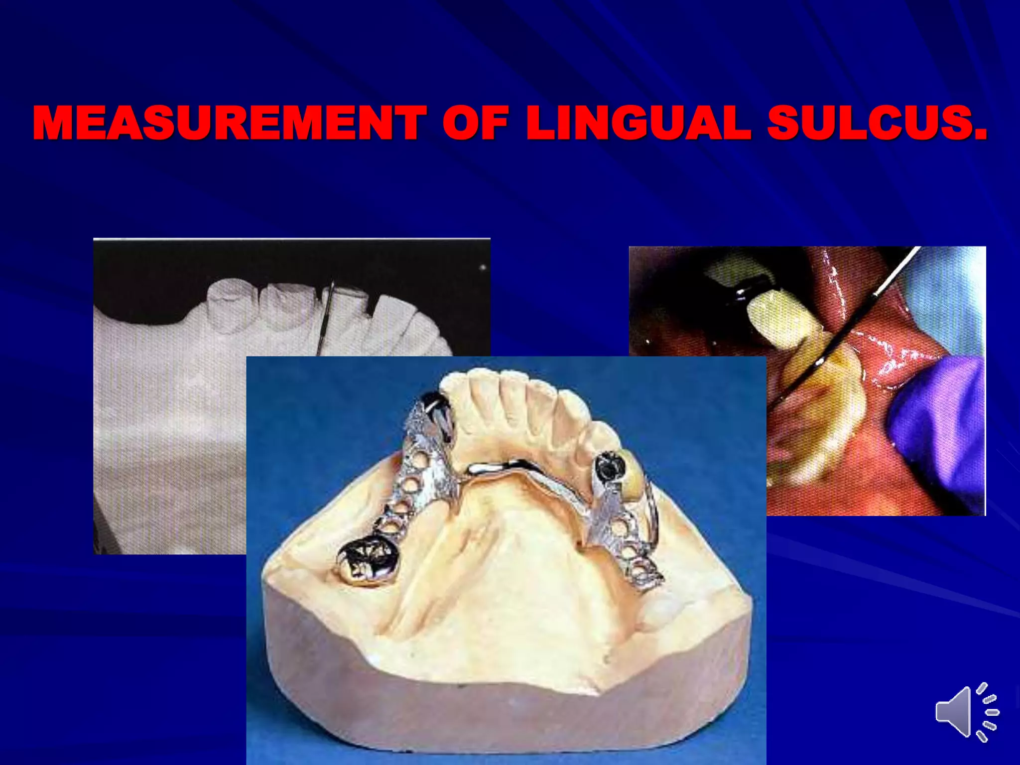 Substandard Rpds Mandibular major and minor connectors of RPDs | PPT