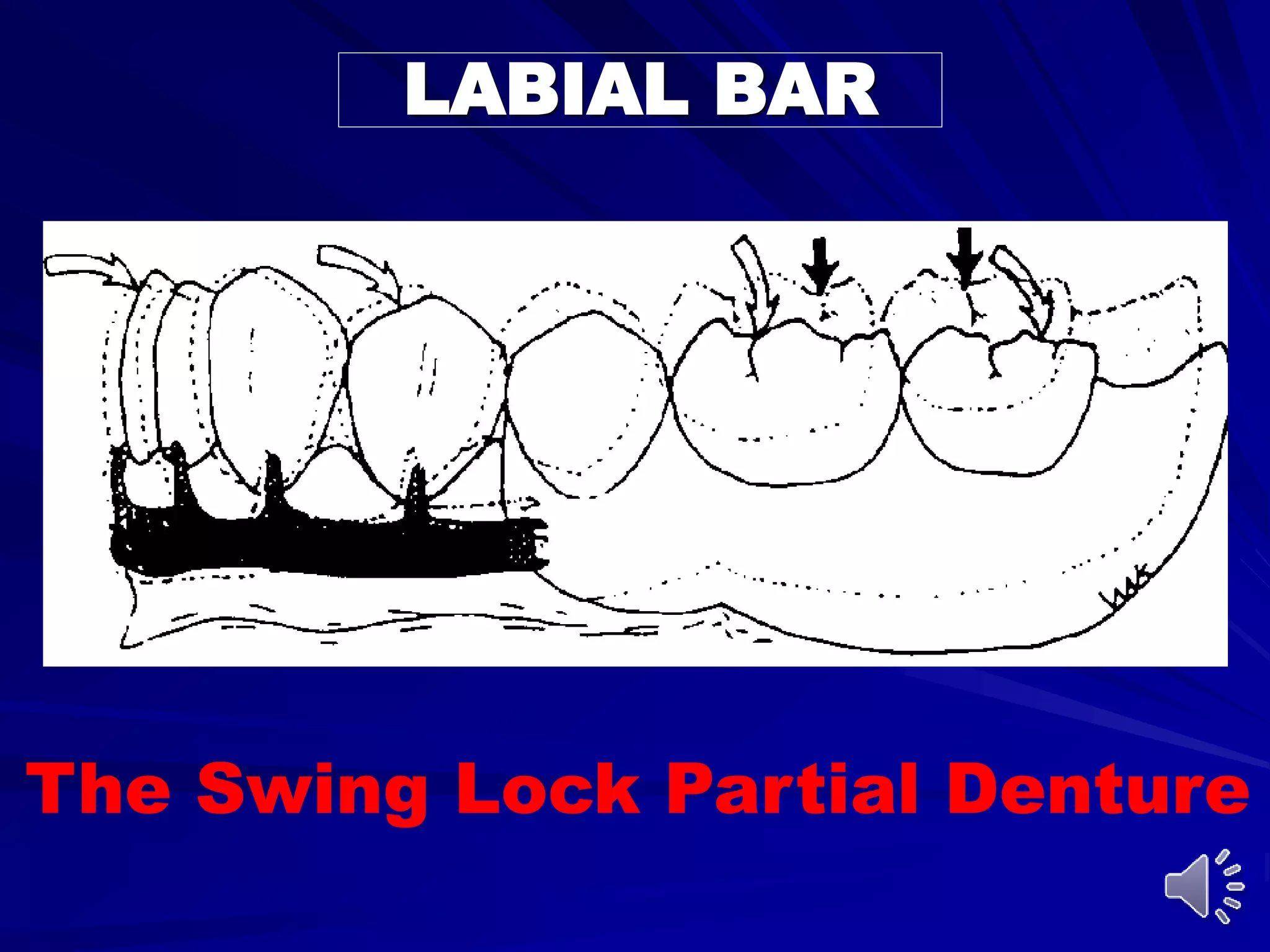 Unilaterl Rpds Mandibular major and minor connectors of RPDs | PPT