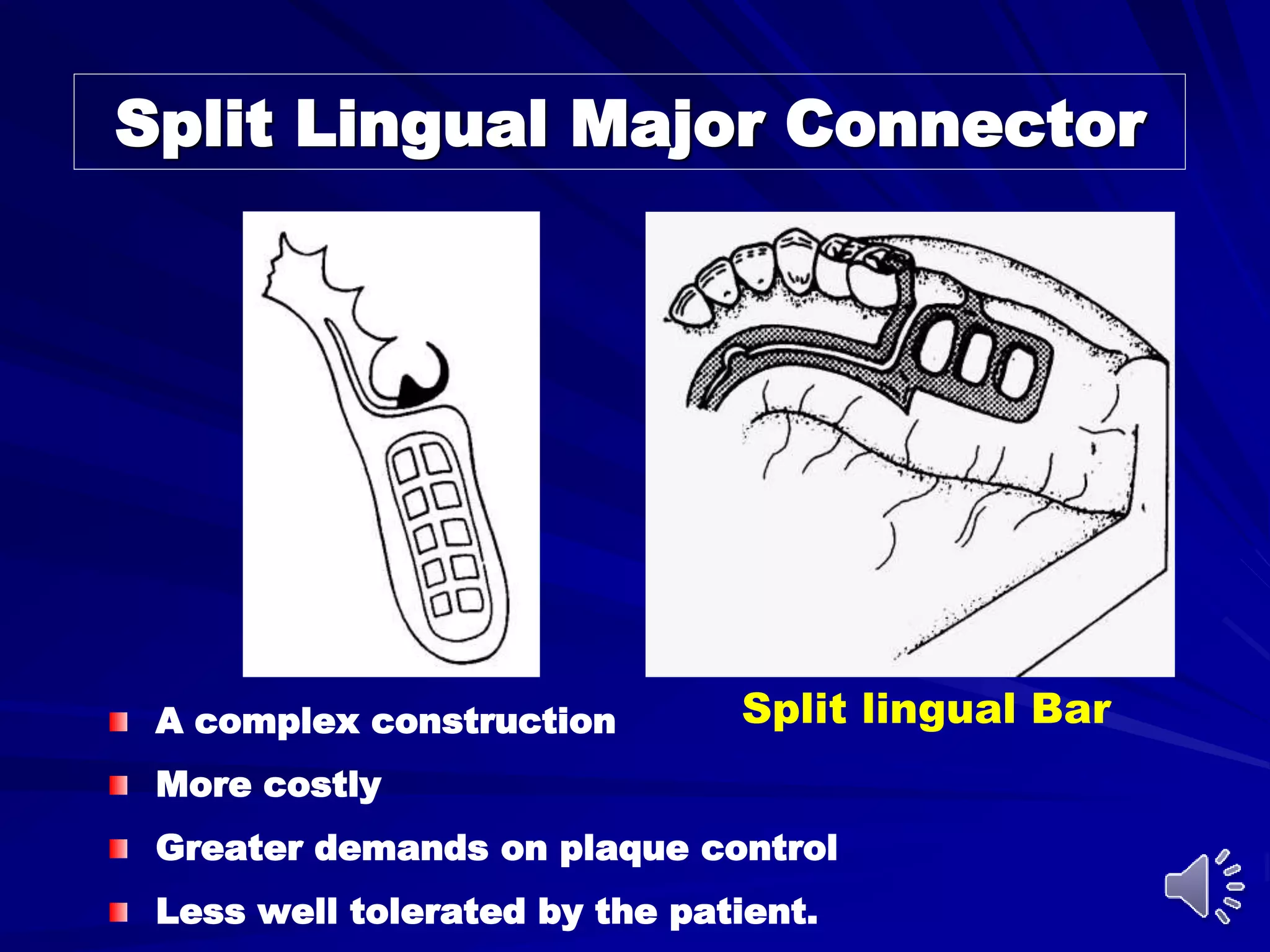 Split Major Connector Rpd Mandibular major and minor connectors of RPDs | PPT